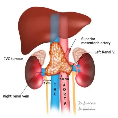 Retroperitoneal sarcomas service image