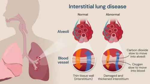 Interstitial Lung Disease (ILD) service image