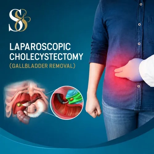 Laparoscopic Cholecystectomy service image