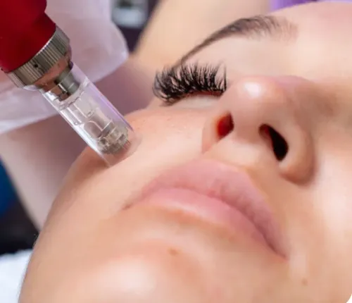Microneedling service image