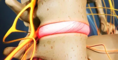 Degenerative Disc Disease service image