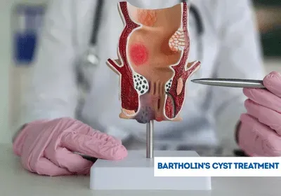 Bartholin Cyst Treatment service image