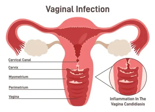 Vaginal Infection and Recurrent Discharge Treatment service image