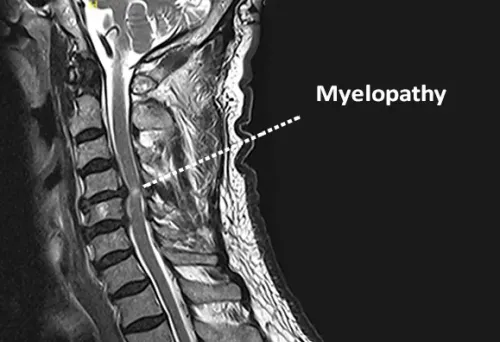 Cervical Myelopathy service image