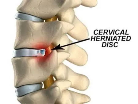 Cervical Disc Prolapse service image