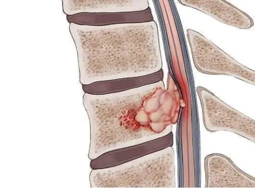 Spine Tumor service image