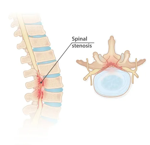Spinal Stenosis service image
