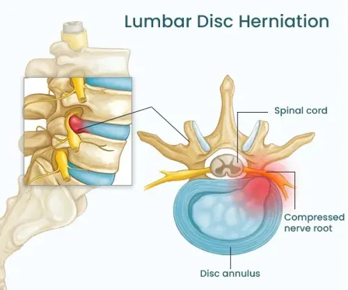 Lumbar Slip Disc service image