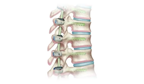 Scoliosis Correction service image