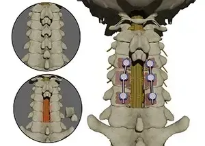 Posterior Cervical Decompression service image