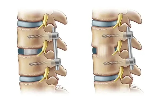 Lumbar (MIS-TLIF) service image