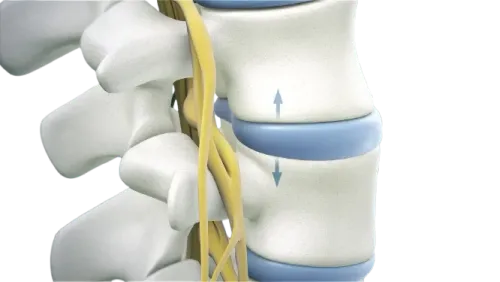 Spinal Decompression Surgery service image