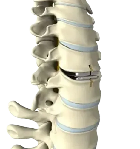 Cervical Disc Replacement service image