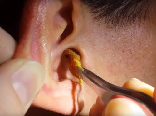 Ear Wax Removal service image