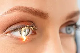 LASIK service image