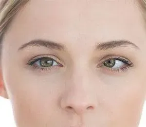 Amblyopia service image