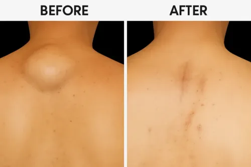 Lipoma removal Treatment service image