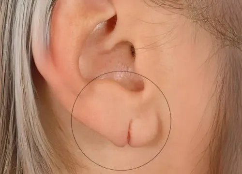 Ear Lobe Repair service image
