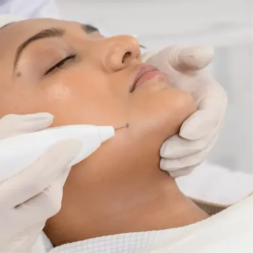 Mole removal service image