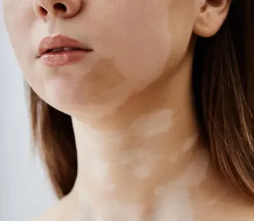 Vitiligo surgery service image