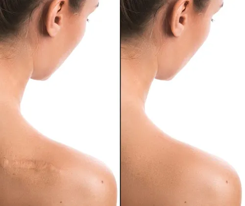 Scar Revision Treatment service image