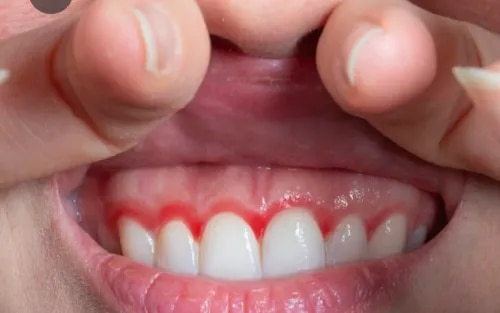Gum Disease Treatment service image