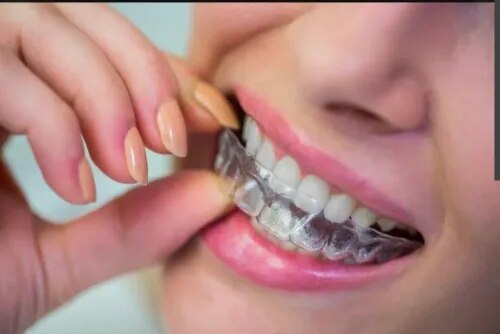 Invisalign® / Clear Aligners Treatment  service image