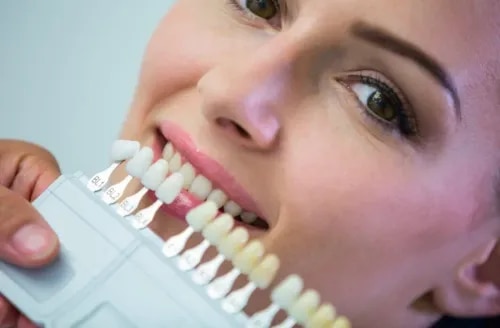 Dental Veneers (E.max Veneers)  service image