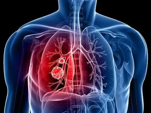 Thoracic Malignancies service image