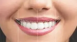 Smile Designing service image