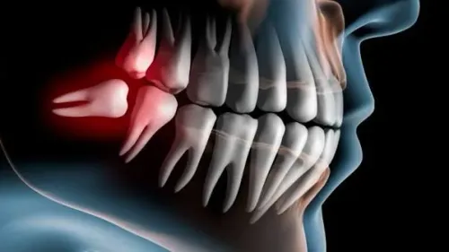 Wisdom Tooth Removal service image