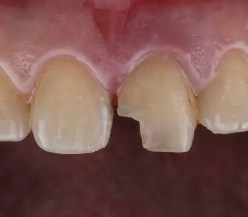Broken or Chipped Tooth Consultation service image