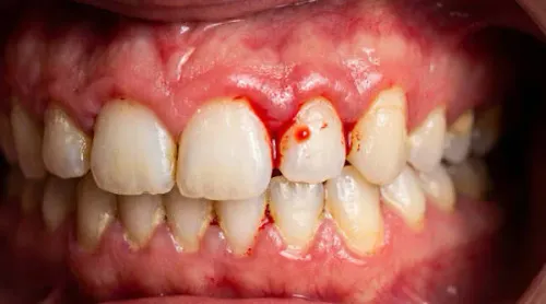 Bleeding Gums Treatment  service image
