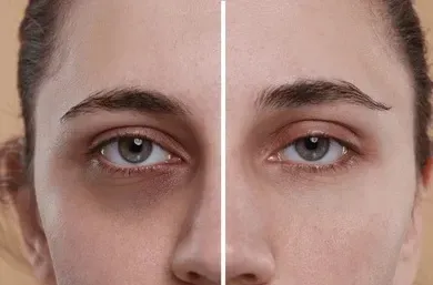 Dark Circle Removal service image