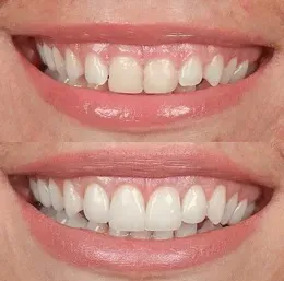 Smile Makeover  service image