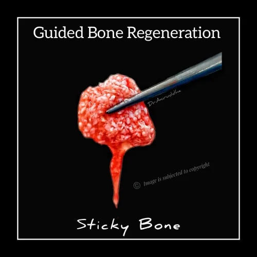 Jaw Bone Grafting Implant Bone Grafting Guided Bone Regeneration service image