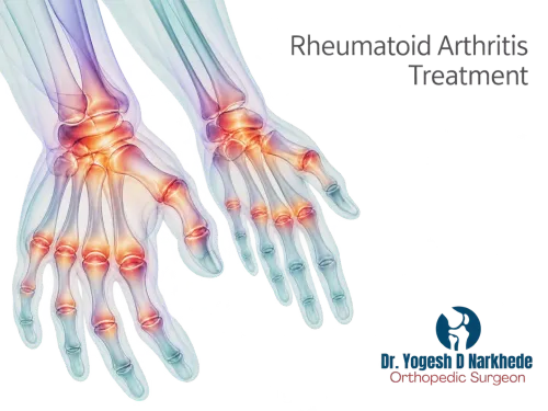 Rheumatoid Arthritis Treatment service image
