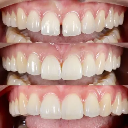 Tooth colored filling service image