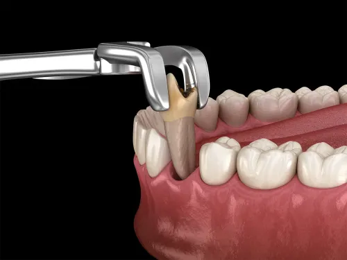 Painless tooth extraction service image