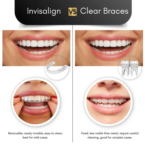 Invisalign and Aligners/ Braces -Metal/ceramic/self-ligating service image