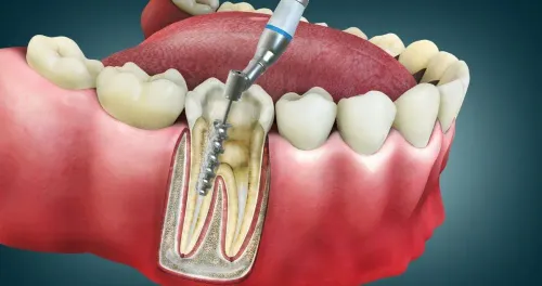 Root canal treatment service image