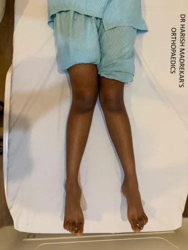 KNEE DEFORMITY CORRECTION IN CHILDREN service image
