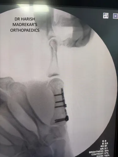 Rolando Fractur -intra-articular fracture at the base of the first metacarpal  service image