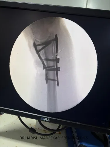 DISTAL END RADIUS FRACTURE - WRIST BONE FRACTURE service image