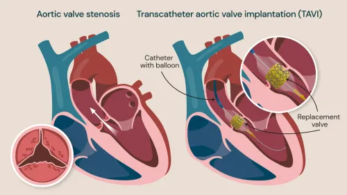 TAVI / TAVR Procedure  service image