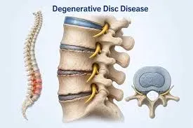Degenerative Spine Disorders service image