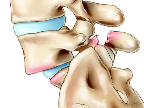 Spondylolisthesis service image