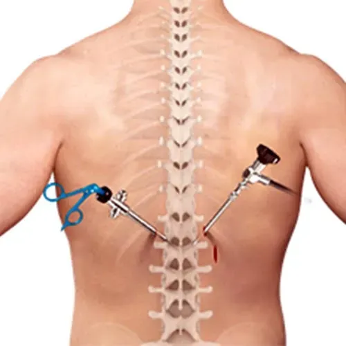 Minimally Invasive Spine Surgery service image