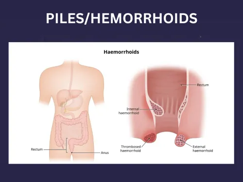 PILES/HEMORRHOIDS service image