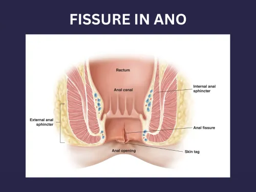 FISSURE IN ANO service image
